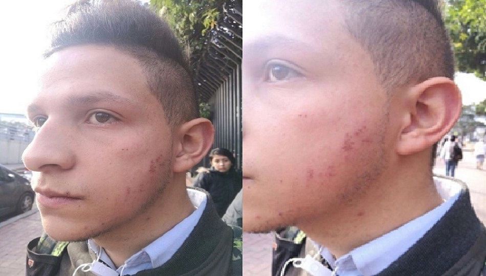 David Montoya, Integrante de la comunidad LGTBI, muestra las heridas en el rostro.|||