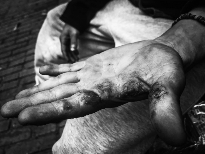 Consecuencias del basuco en las manos de Enrique, despu&eacute;s de 7 a&ntilde;os viviendo en las calles